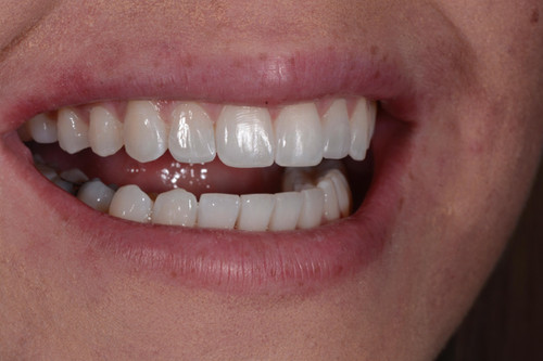 Composite bonding course with Dr Affan at ACE Courses