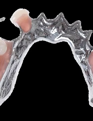 Partial denture with a metal framework