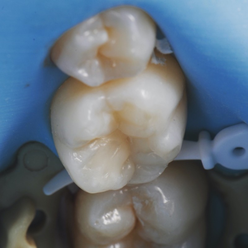 IndigoDent Posterior Composite Course