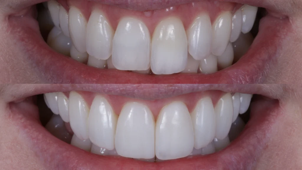 COMP 1 anterior composite clinical case before and after