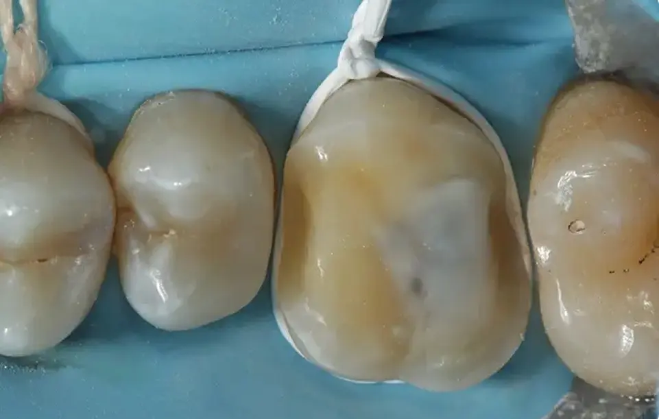 FIPO clear preparation protocol clinical case